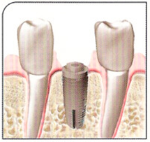 Teeth implants figure - Jason Erasmus