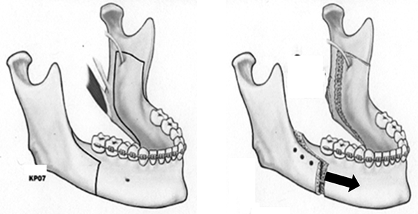 Orthognathic Surgery - Jason Erasmus