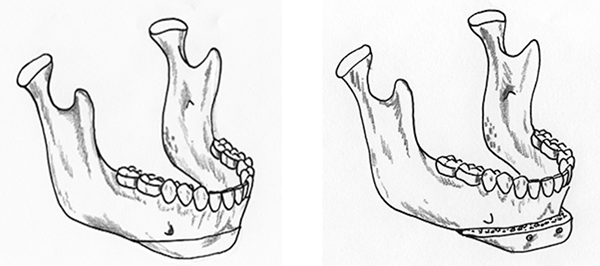 Orthognathic Surgery - Jason Erasmus